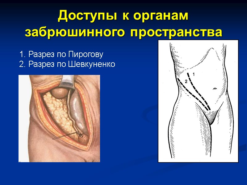 Доступы к органам  забрюшинного пространства Разрез по Пирогову Разрез по Шевкуненко